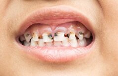 با نشانه‌ها و روش‌های تشخیص و درمان پوسیدگی دندان آشنا شوید