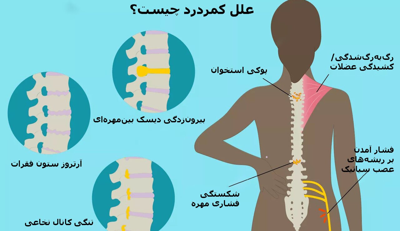 پیشگیری از عود کمردرد با یک عادت روزمره