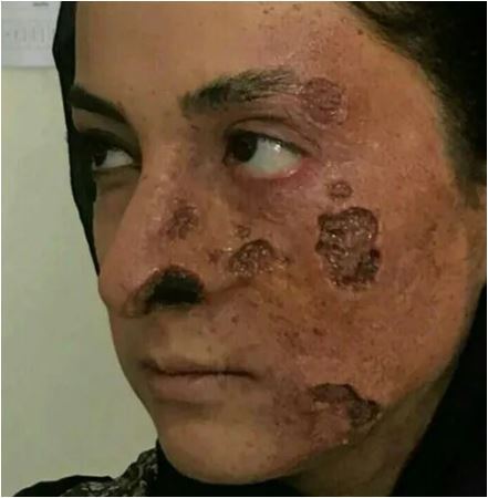 لیست کامل بازیگرانی که با گریم جذامی جلوی دوربین ظاهر شدند/ از المیرا دهقانی بازیگر سریال لحظه گرگ و میش تا... +عکس لیست کامل بازیگرانی که با گریم جذامی جلوی دوربین ظاهر شدند/ از المیرا دهقانی بازیگر سریال لحظه گرگ و میش تا... +عکس