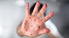 وزارت بهداشت درمورد شیوع بیماری «سرخک» در عراق خبر داد