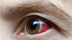 درباره علائم و روش تشخیص و درمان سکته چشمی بیشتر بدانید