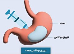 بوتاکس معده؛ عوارض و شرایط آن