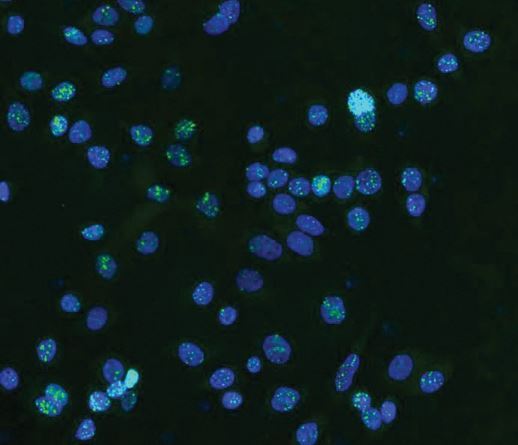 تشخیص و درمان سرطان به کمک DNA غیر کدگذاری شده