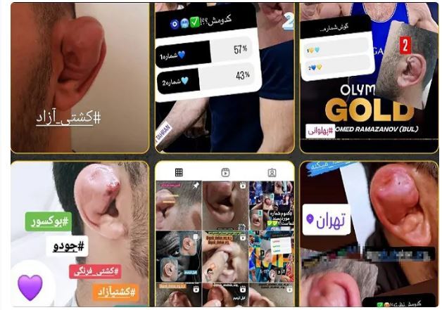 عکس/ عمل جراحی برای شبیه شدن به حسن یزدانی مُد شد!