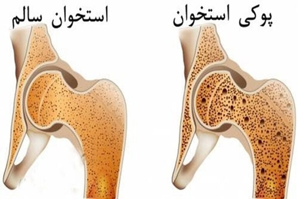 علت شایع درد زانو چیست؟