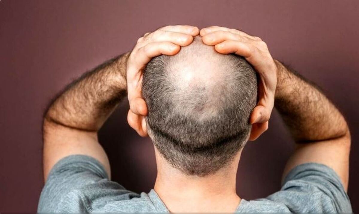 رفع مشکل طاسی ممکن می‌شود؟