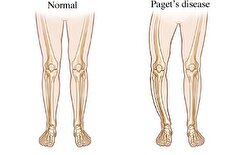 عوارض و روش‌های درمان و پیشگیری از بیماری پاژه