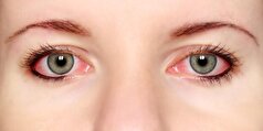 عفونت عامل اصلی قرمزی چشم و روش‌های درمان خانگی این بیماری