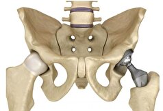 آرتروپلاستی کامل ران مؤثرترین روش جراحی در درمان مشکلات شدید مفصل ران!