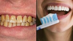 آیا بلیچینگ روشی مناسب برای رفع زردی دندان‌ها است؟