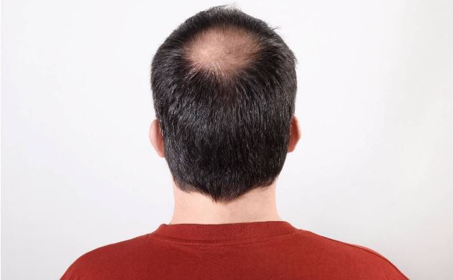 آشنایی با چرخه مرگ و زندگی موها/چه مقدار ریزش در روز نرمال است؟