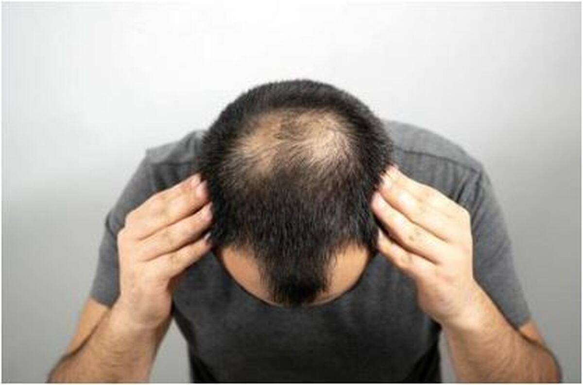 اگر از ریزش مو‌ها هراسانید این ویتامین‌ها را مصرف کنید