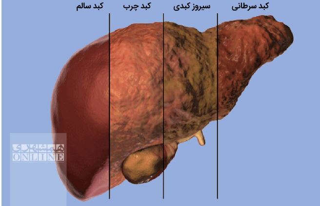 همه چیز درمورد بیماری کبد چرب/از علل تا علائم