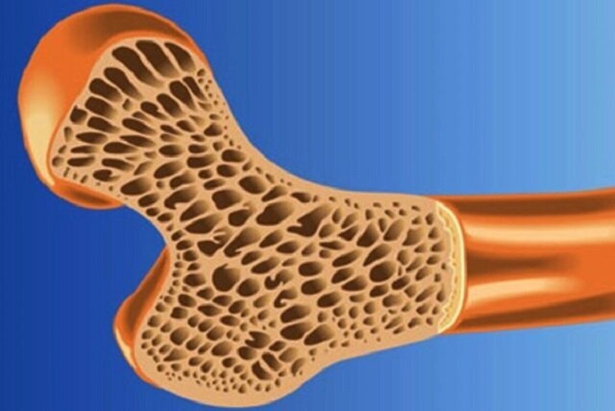 شکستگی لگن منجر به فوت میشود؟