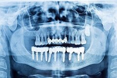 اهمیت تصویربرداری در فرآیند درمان دندانپزشکی در زمینه ایمپلنت‌ها