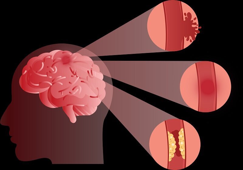 سکته مغزی؛ یک قاتل خاموش /علل و علائم ابتلا