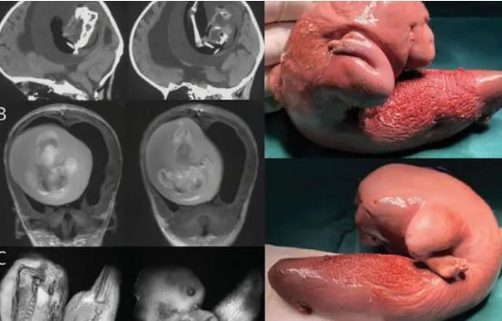تصویری از یک جنین مرده در سر کودک یک ساله!