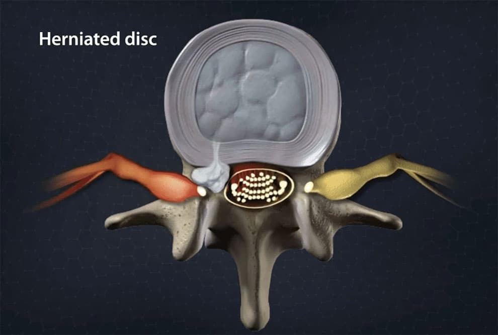 علت و علائم و راه‌های درمان فتق دیسک کمر چیست؟