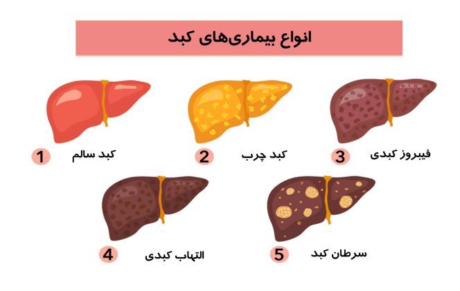 درمورد بیماری کبد چرب گرید ۳ بیشتر بدانید
