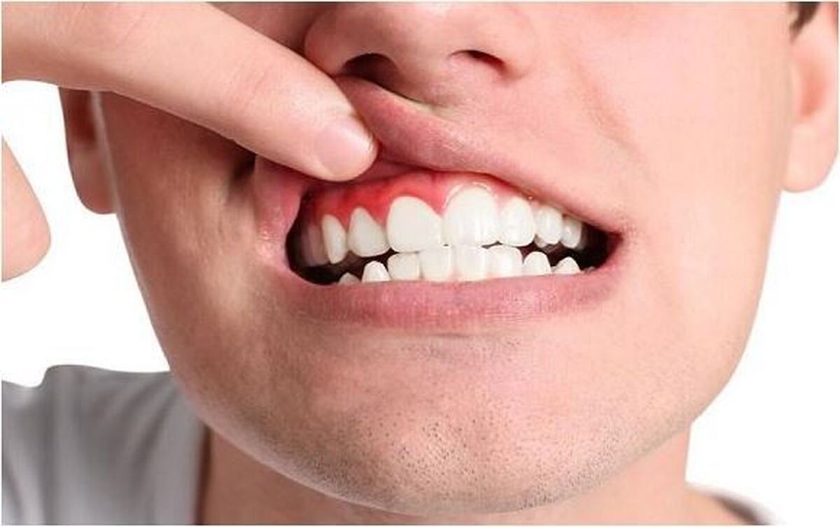 چرا لثه‌ها سیاه می‌شوند؟