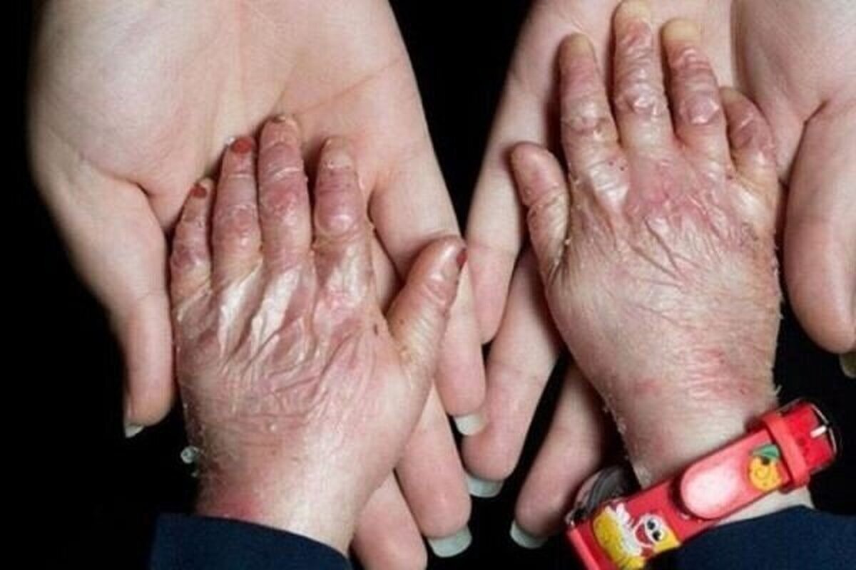 نشاندار شدن ۶ بیمار پروانه‌ای در گیلان