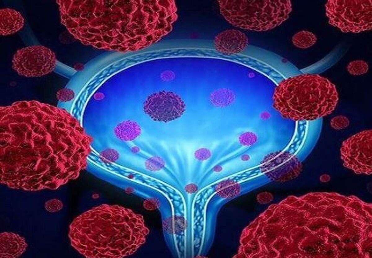 دود سیگار عاملی برای ابتلا به سرطان مثانه!