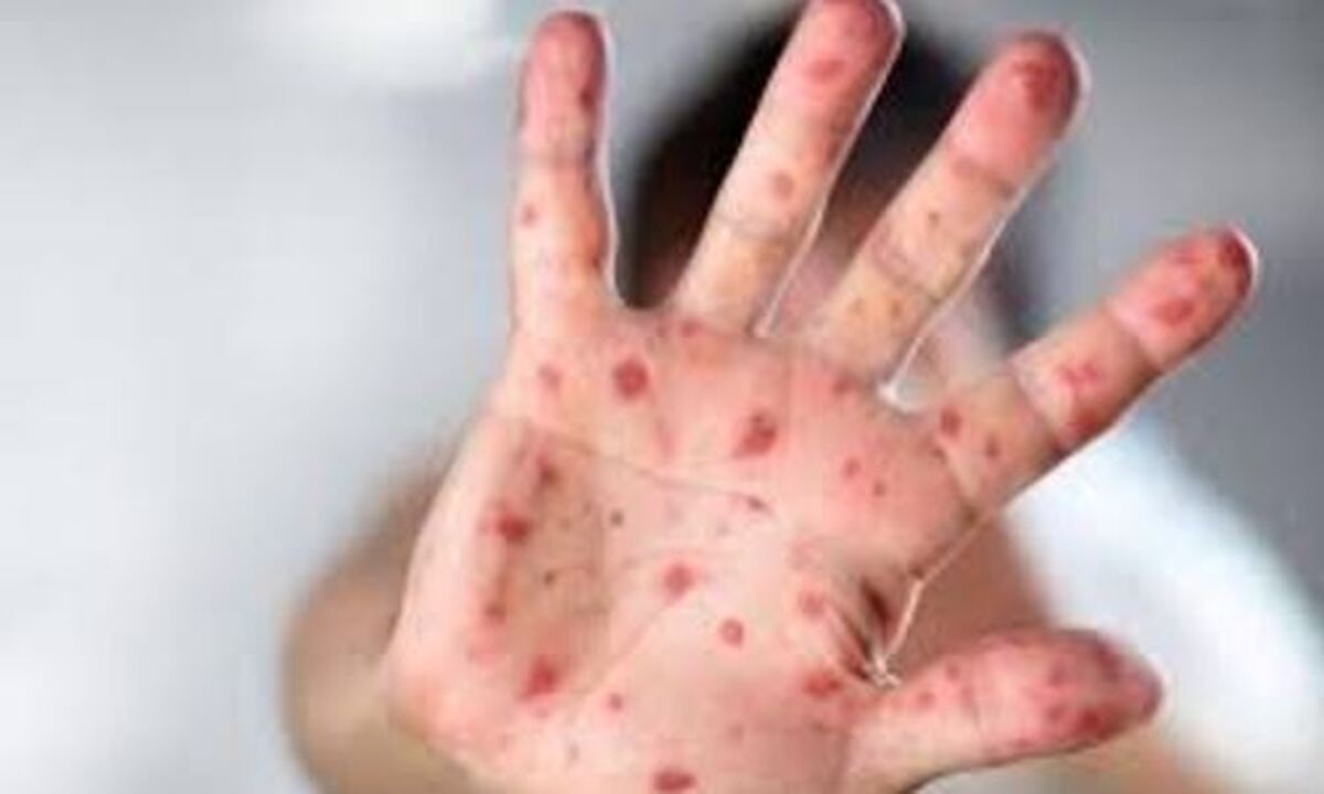 ۶۰۰ درصد افزایش برای موارد ابتلا به mpox!