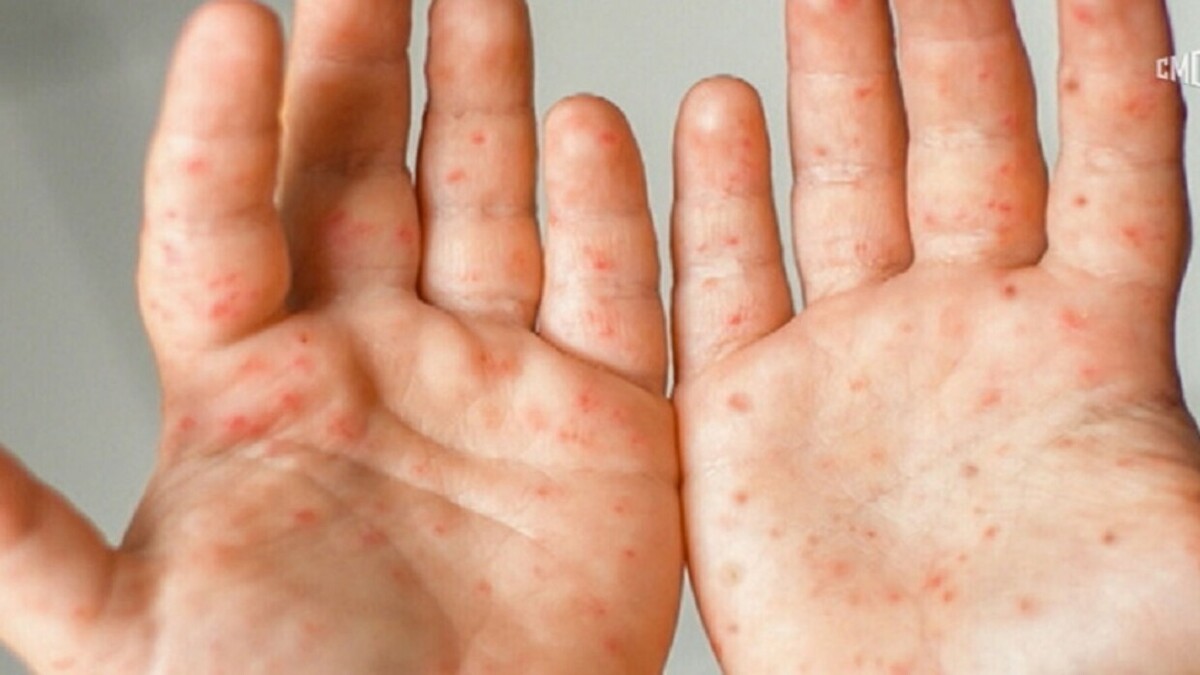 چگونه می‌توان بین coxsackievirus، سرخجه و آبله مرغان تمایز قائل شد؟