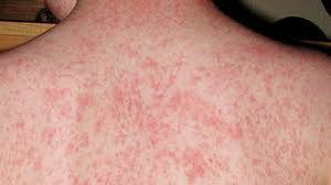 چگونه می‌توان بین coxsackievirus، سرخجه و آبله مرغان تمایز قائل شد؟