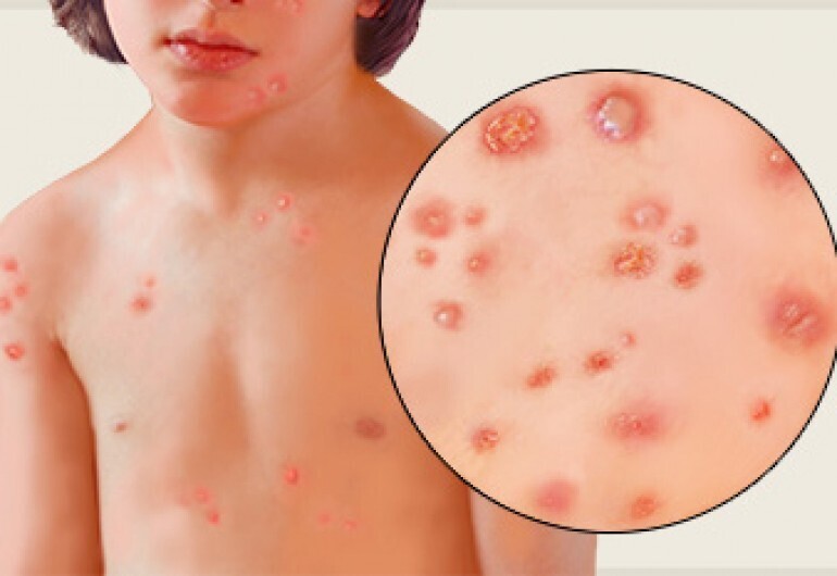 چگونه می‌توان بین coxsackievirus، سرخجه و آبله مرغان تمایز قائل شد؟