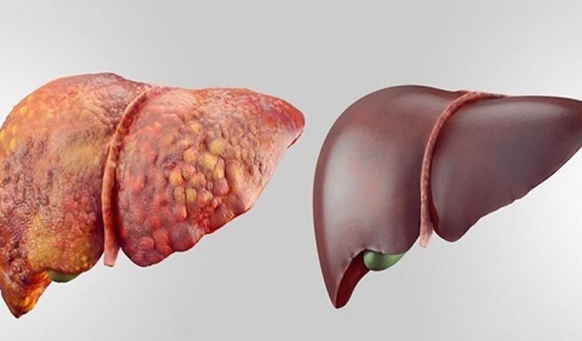 ضرورت غربالگری سرطان روده