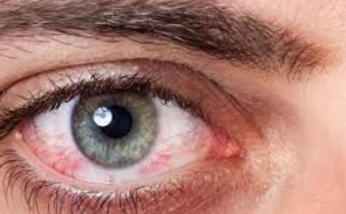 چگونه از عفونت‌های چشمی پیشگیری کنیم؟