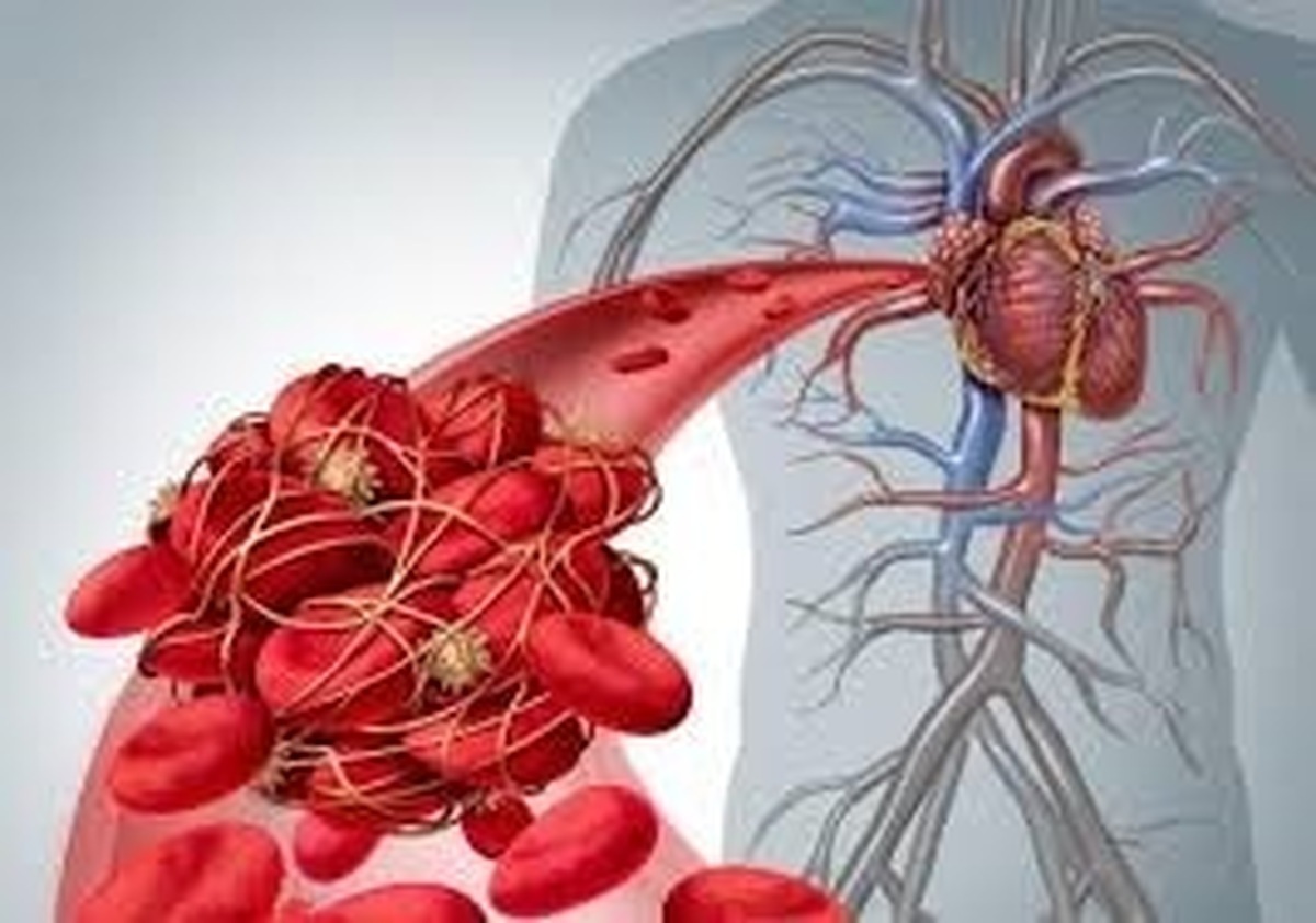 اقدامات پیشگیرانه از لخته شدن خون در مواقع مختلف!