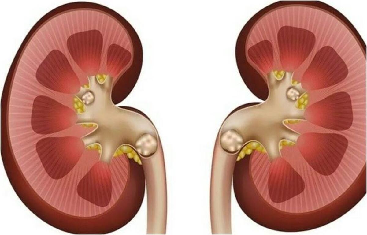 راه‌های مقابله با سنگ کلیه را بیشتر بشناسید