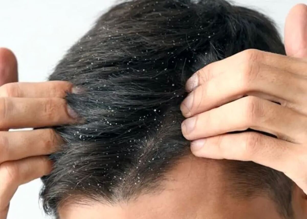 با این روش طلایی از شر شوره‌های سر راحت شوید