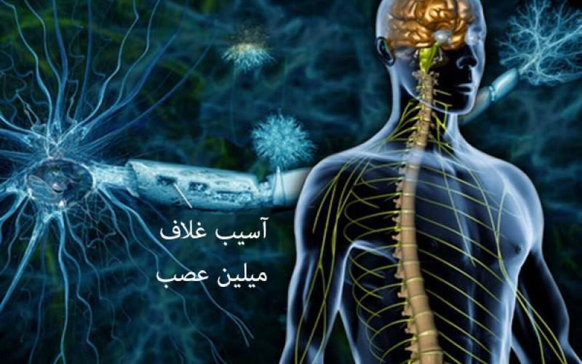 همه چیز‌هایی که باید در مورد‌ام اس بدانید!