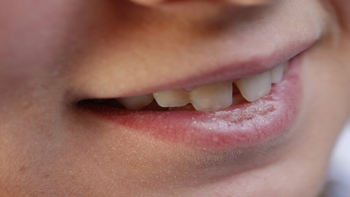 چگونه در زمستان از ترک خوردن لب‌ها جلوگیری کنیم؟