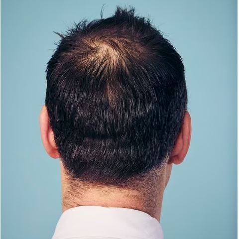 آیا امکان بازیابی مو‌های ریخته شد وجود داد؟ /از طاسی فرار کنید