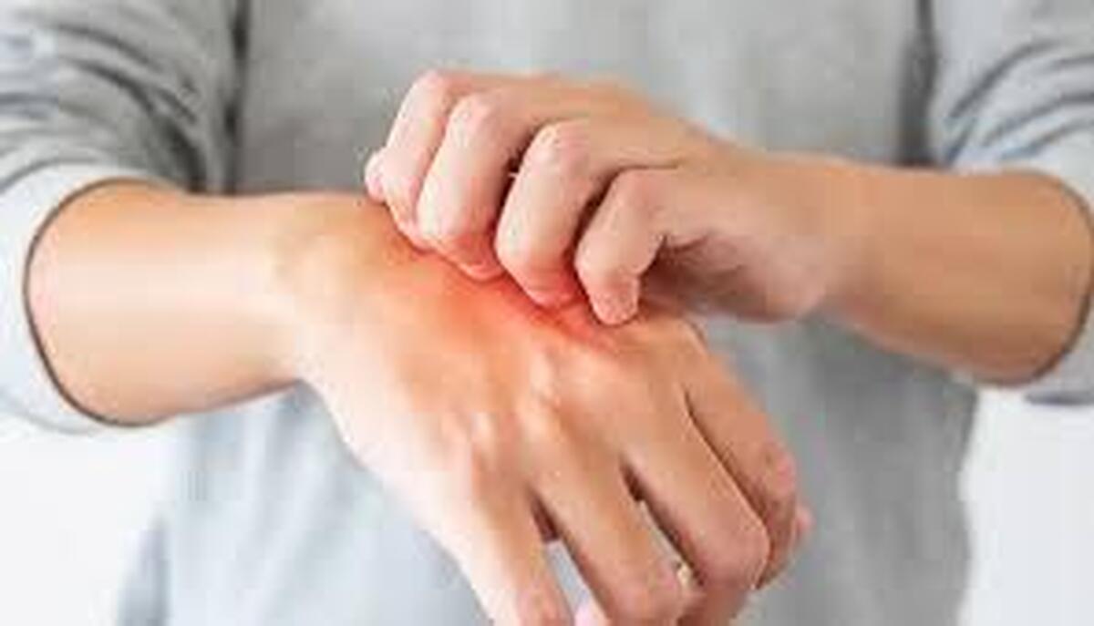 خارش در بیماری‌های کبدی را چگونه میتوان درمان کرد؟