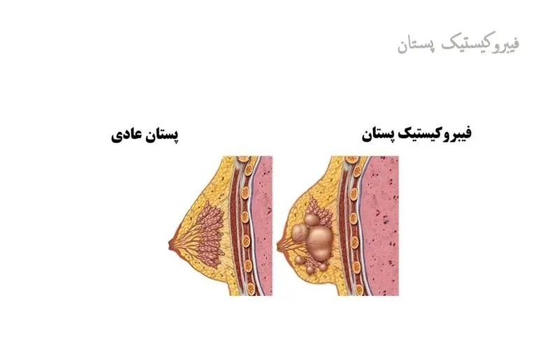 با حذف این مواد غذایی بیماری فیبروکیستیک سینه را درمان کنید