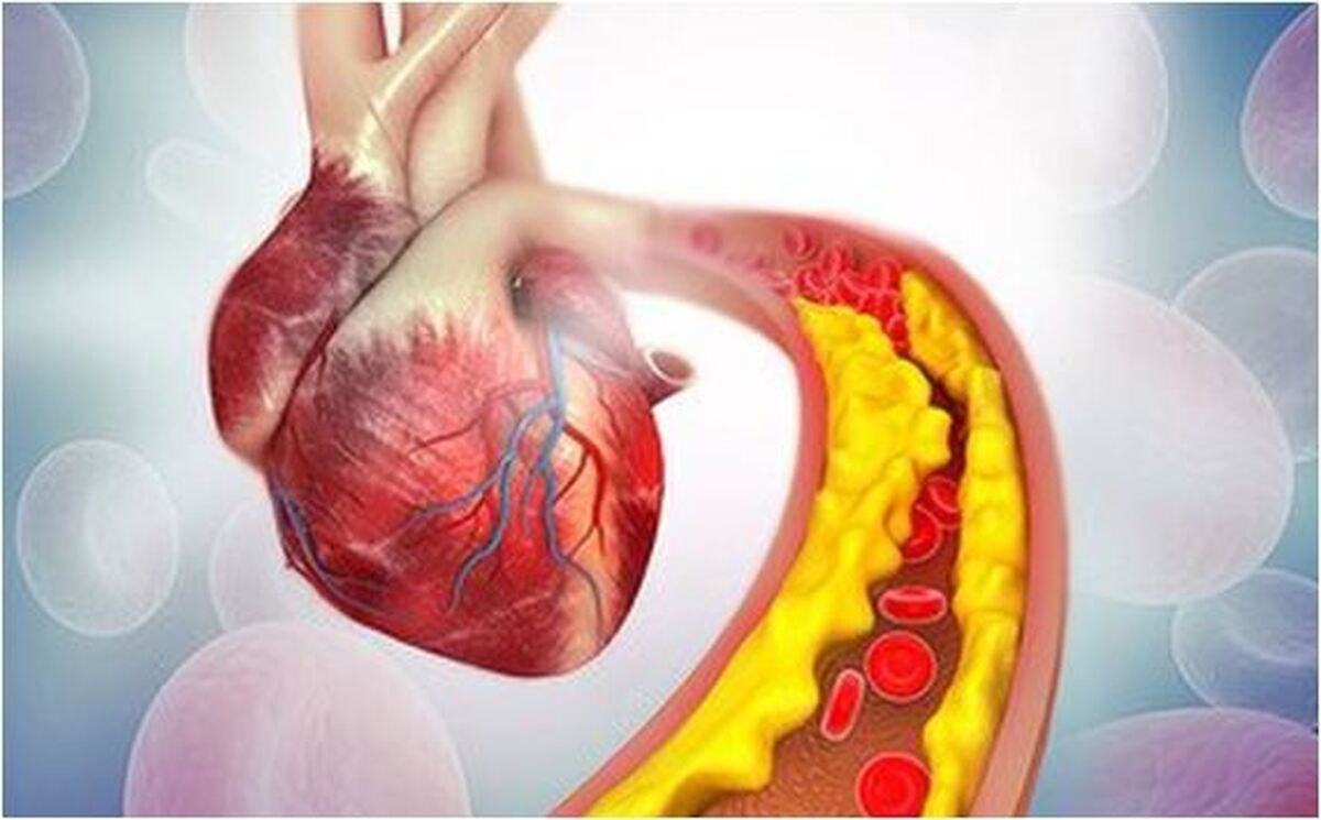 مکمل پیشنهادی برای کاهش چربی خون