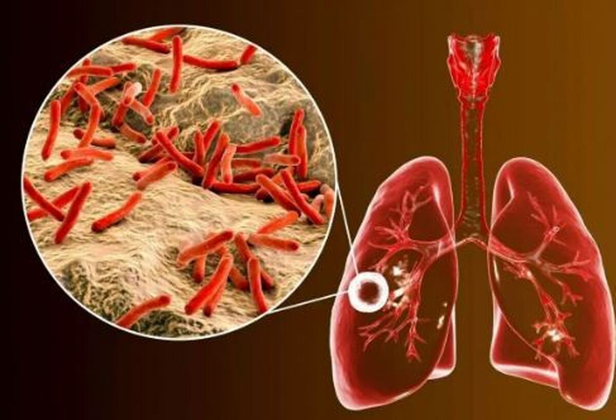 سل؛ بیماری مرگبار عفونی /از چگونگی انتقال تا پیشگیری از ابتلا
