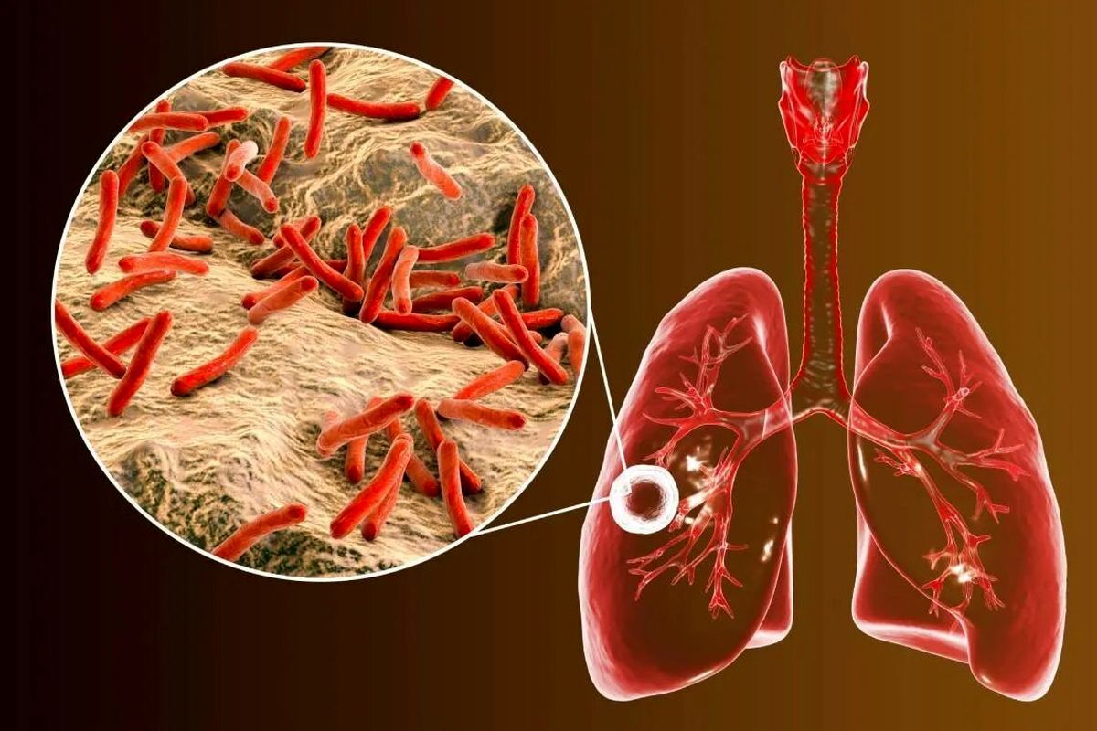 اگر بیماری سل به موقع تشخیص داده نشود، چه میشود؟