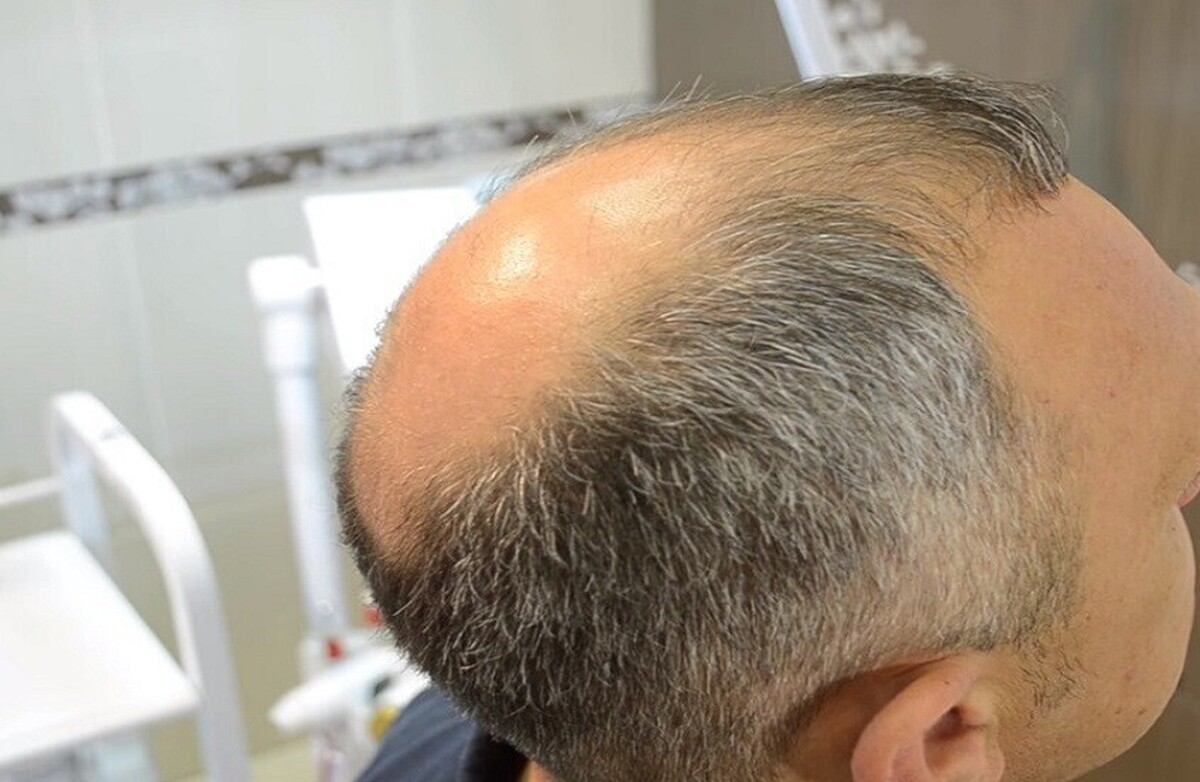 کشف جدید امید برای مبارزه با طاسی را زنده کرد