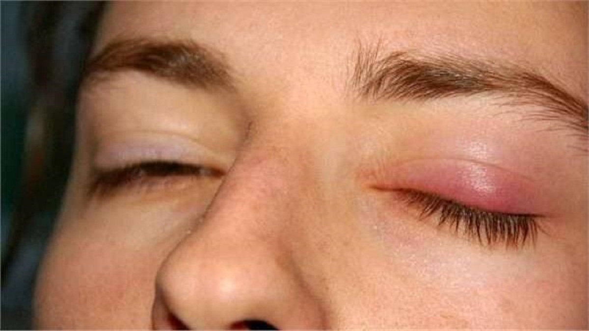 کیست‌های چربی چشم به چه علتی ایجاد میشوند؟