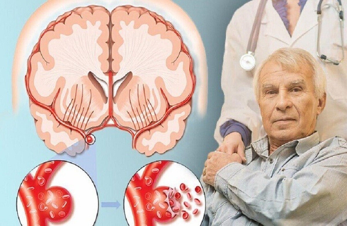 روسیه| هوش مصنوعی به تشخیص ژن‌های مرتبط با سکته مغزی کمک می‌کند