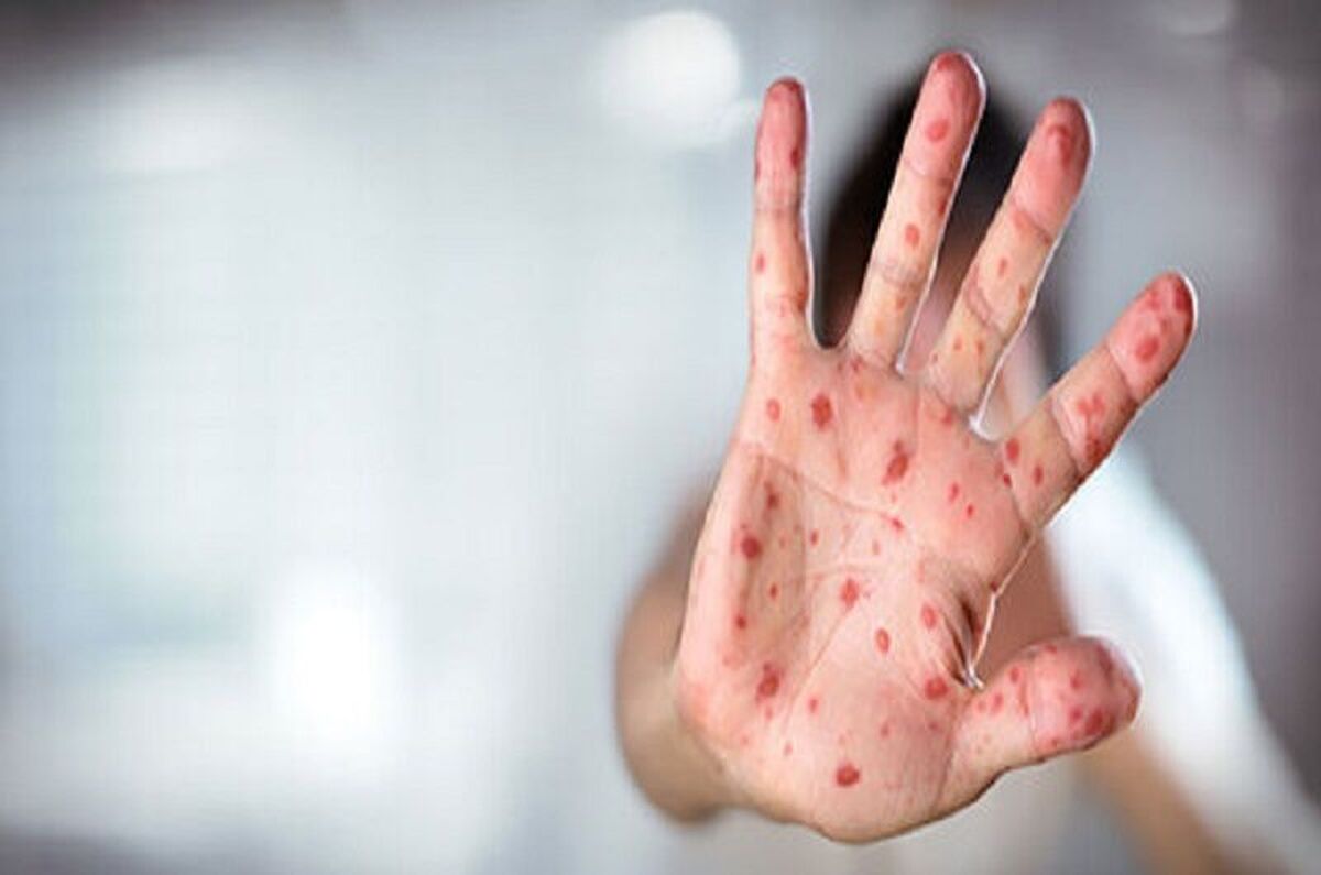 مرگ سومین فرد در آمریکا به دلیل بیماری سرخک