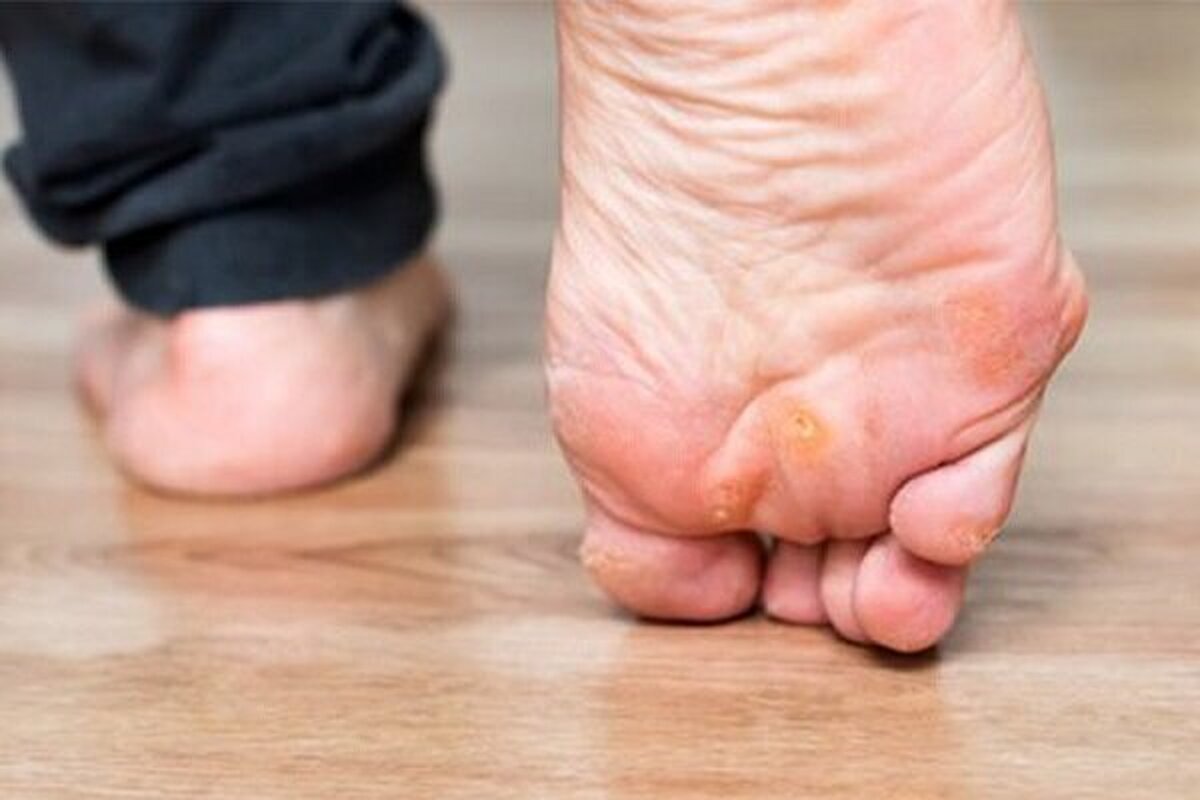 نگاهی به تفاوت‌های میخچه پا و زگیل/چگونه از ایجاد میخچه جلوگیری کنیم؟