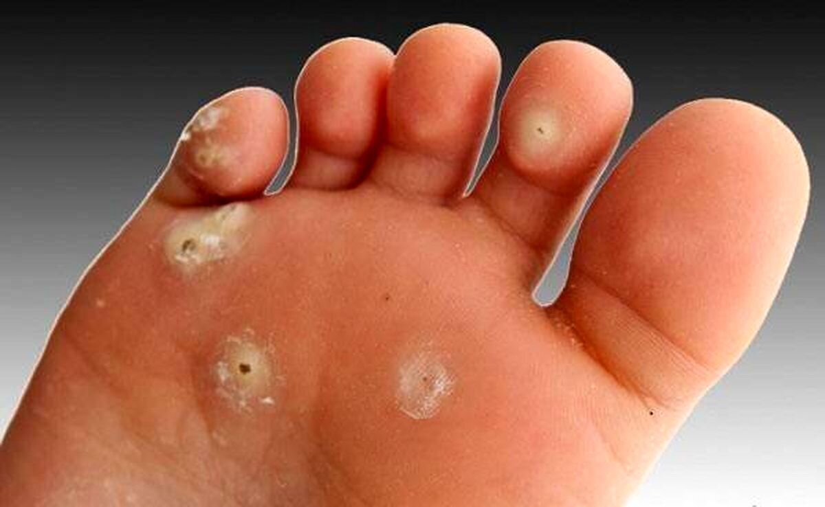 نگاهی به تفاوت‌های میخچه پا و زگیل/چگونه از ایجاد میخچه جلوگیری کنیم؟