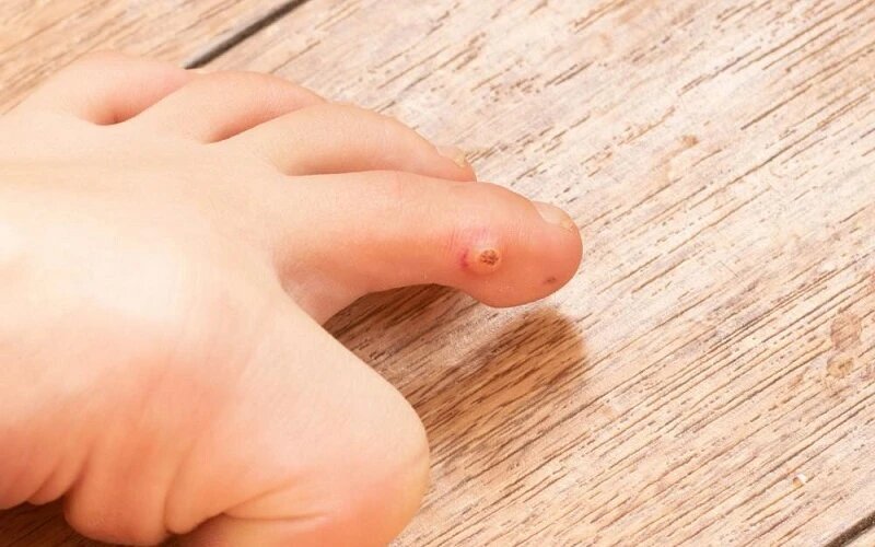 نگاهی به تفاوت‌های میخچه پا و زگیل/چگونه از ایجاد میخچه جلوگیری کنیم؟